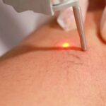 temoignage-apres-operation-des-varices-laser