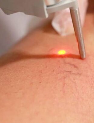 temoignage-apres-operation-des-varices-laser