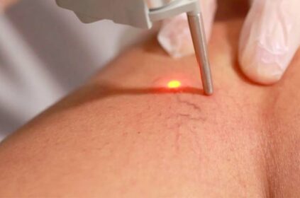 temoignage-apres-operation-des-varices-laser