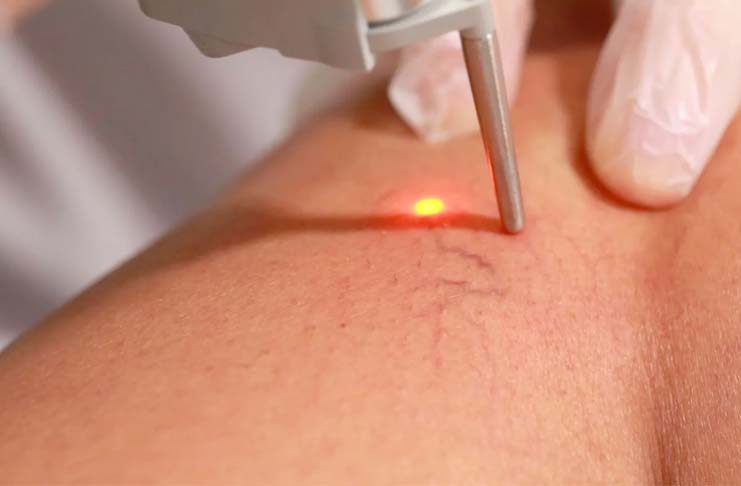 temoignage-apres-operation-des-varices-laser